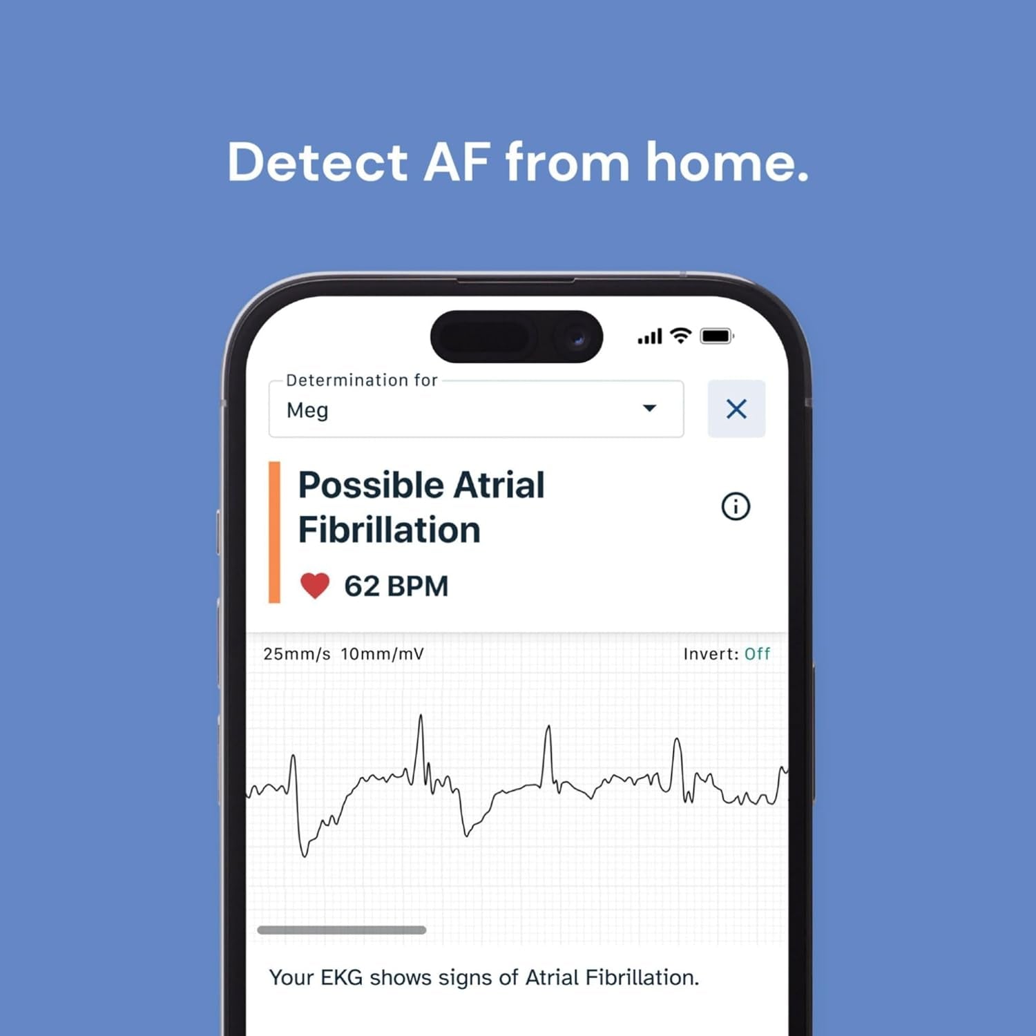 Kardiamobile 1-Lead Personal ECG Heart Rate Monitor - Record Ecgs at Home, Detects Atrial Fibrillation, Trusted by the NHS, Results in 30 Seconds, Works with Most Smartphones